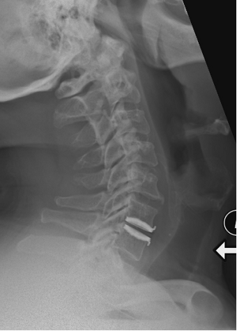 Artificial_Discs_clip_image006.gif