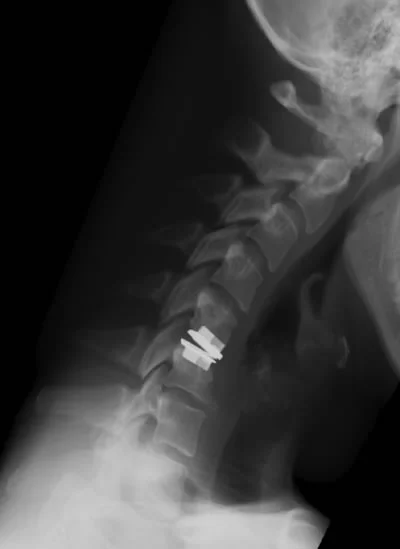 Figure5ProdiscC_in_neckflexion.jpg