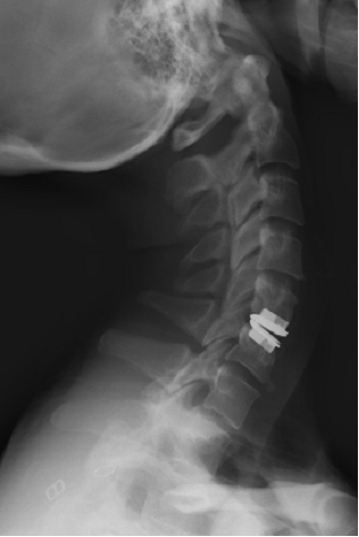 Artificial_Discs_clip_image019.gif