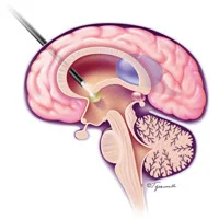 brain_thumb.jpg