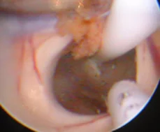 Ventriculoscopy05catheter.jpg