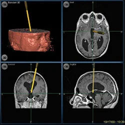 Neuronavi_Hydrocephalus.jpg