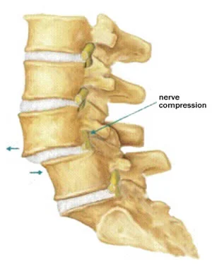 nervecompression.jpg