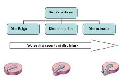 disc_herniation.jpg