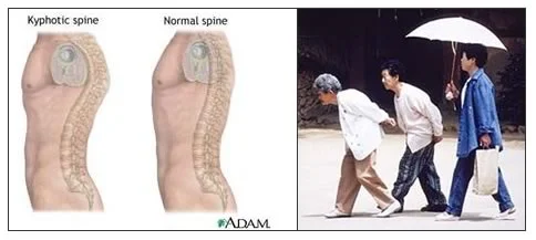 kyphosis.jpg