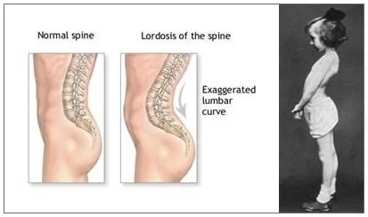 lordosis.jpg