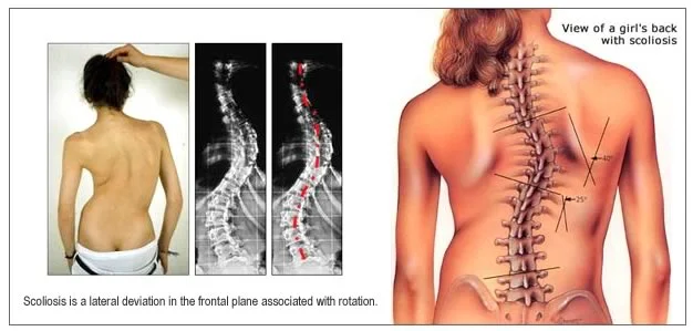 scoliosis.jpg
