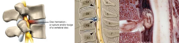 disc_prolapse.jpg