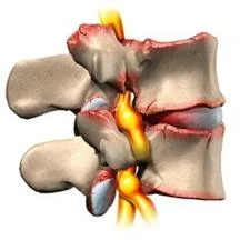 neck_pain_mechanical_disorders_clip_image023.jpg