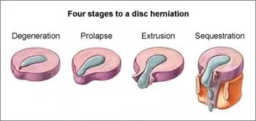 neck_pain_mechanical_disorders_clip_image025.jpg