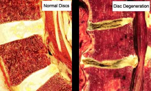 degenerative-disc-disease.jpg