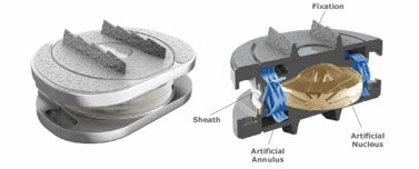 Lumbar-Lower-Back-Disc-Replacement-Surgery_clip_image002.gif