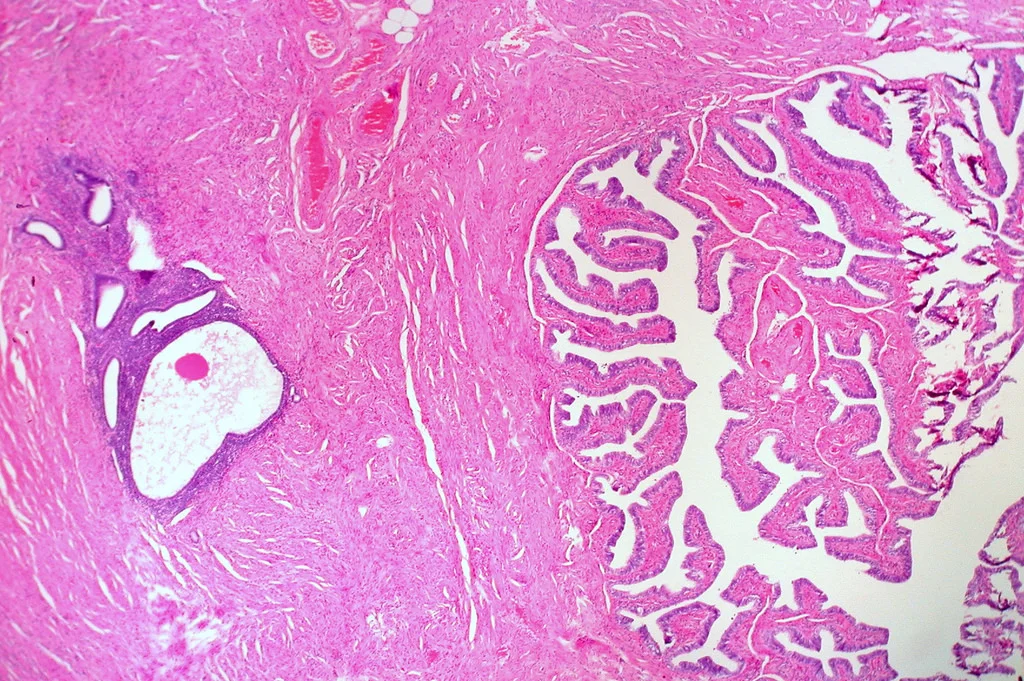 On left: endometriosis in the wall of the Fallopian tube. On right, In a hysterectomy and bilateral salpingo-oophorectomy specimen. On right, native muscosa and lumen of Fallopian Tube. Credit: Ed Uthman via F;ickr.