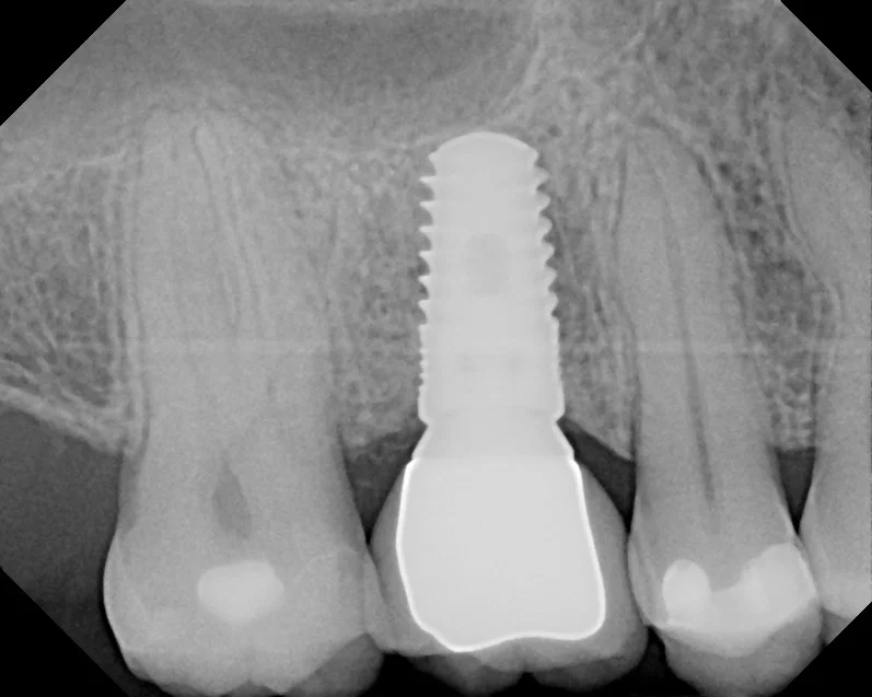implant xray.jpg