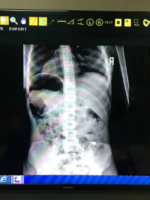 My Experience with Scoliosis and Tips to Manage