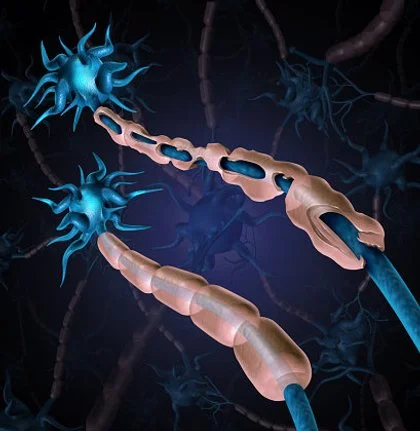 Several serum lipid metabolites are associated with relapse risk in pediatric-onset multiple sclerosis.