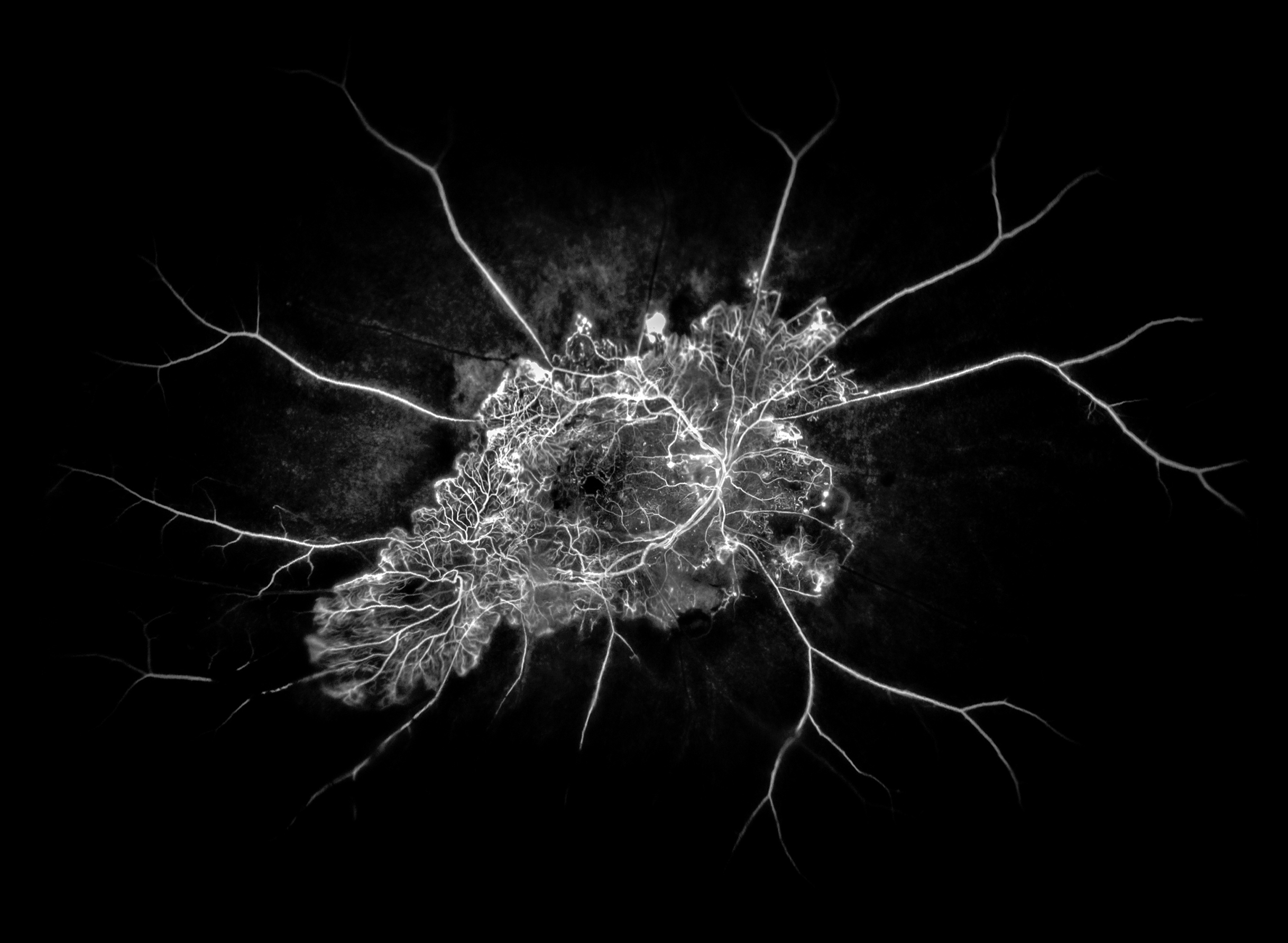 1st place FA/ICG Angiography