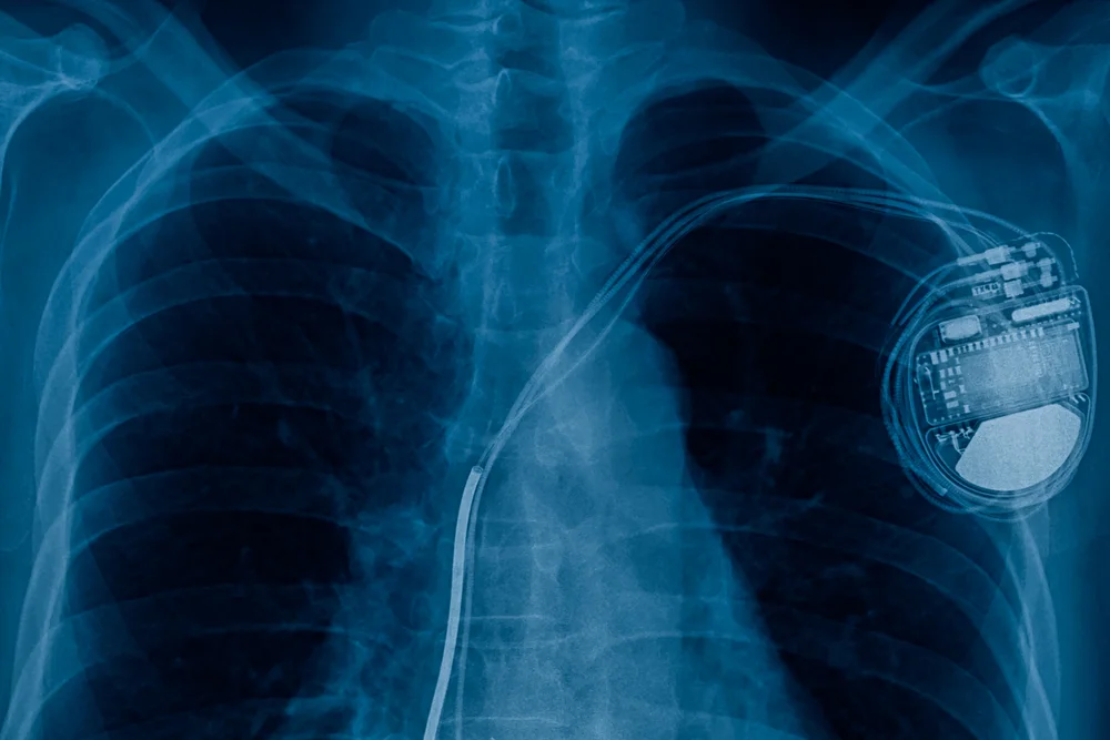 pacemaker.jpg