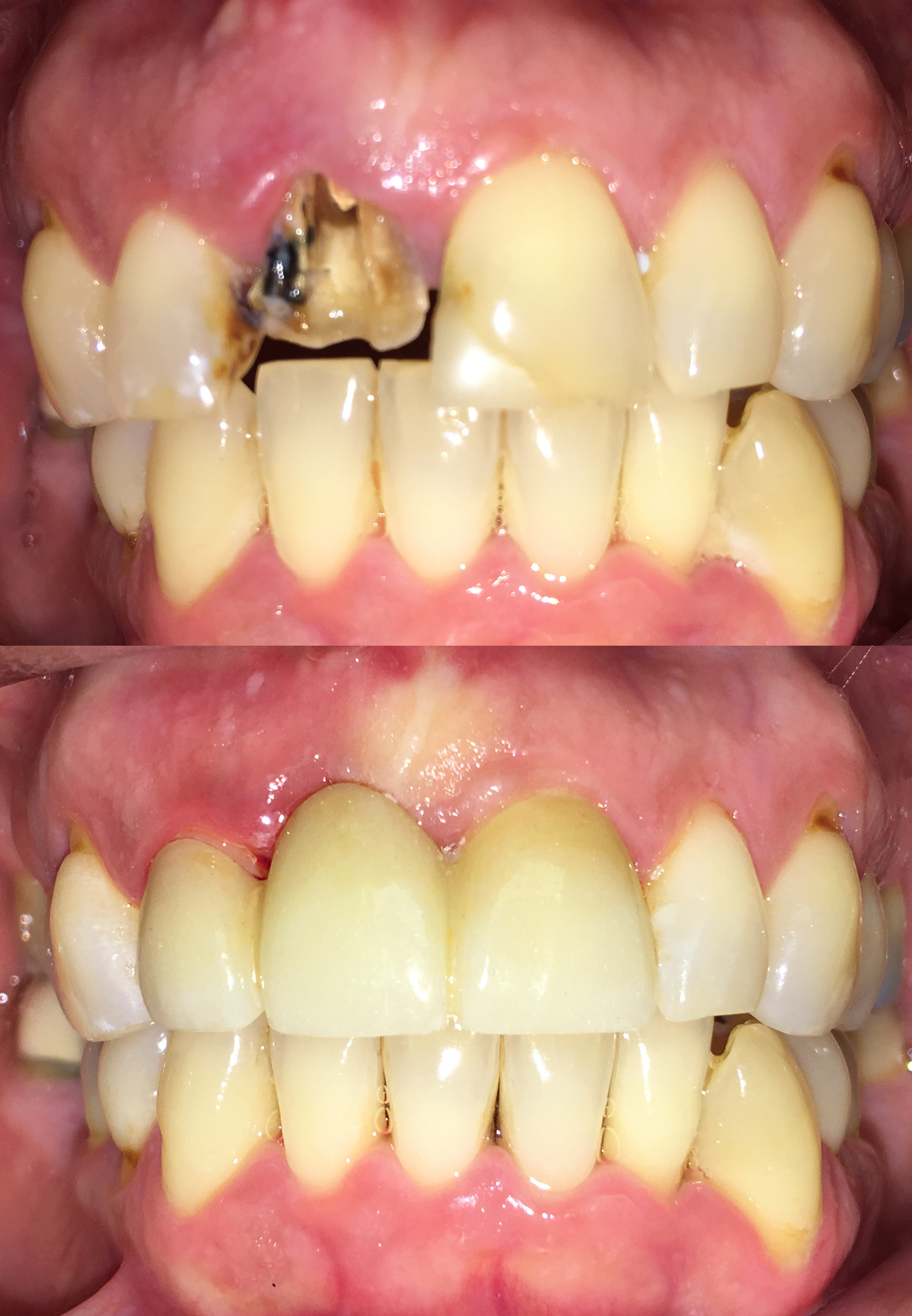 Extraction and bridge to replace missing tooth