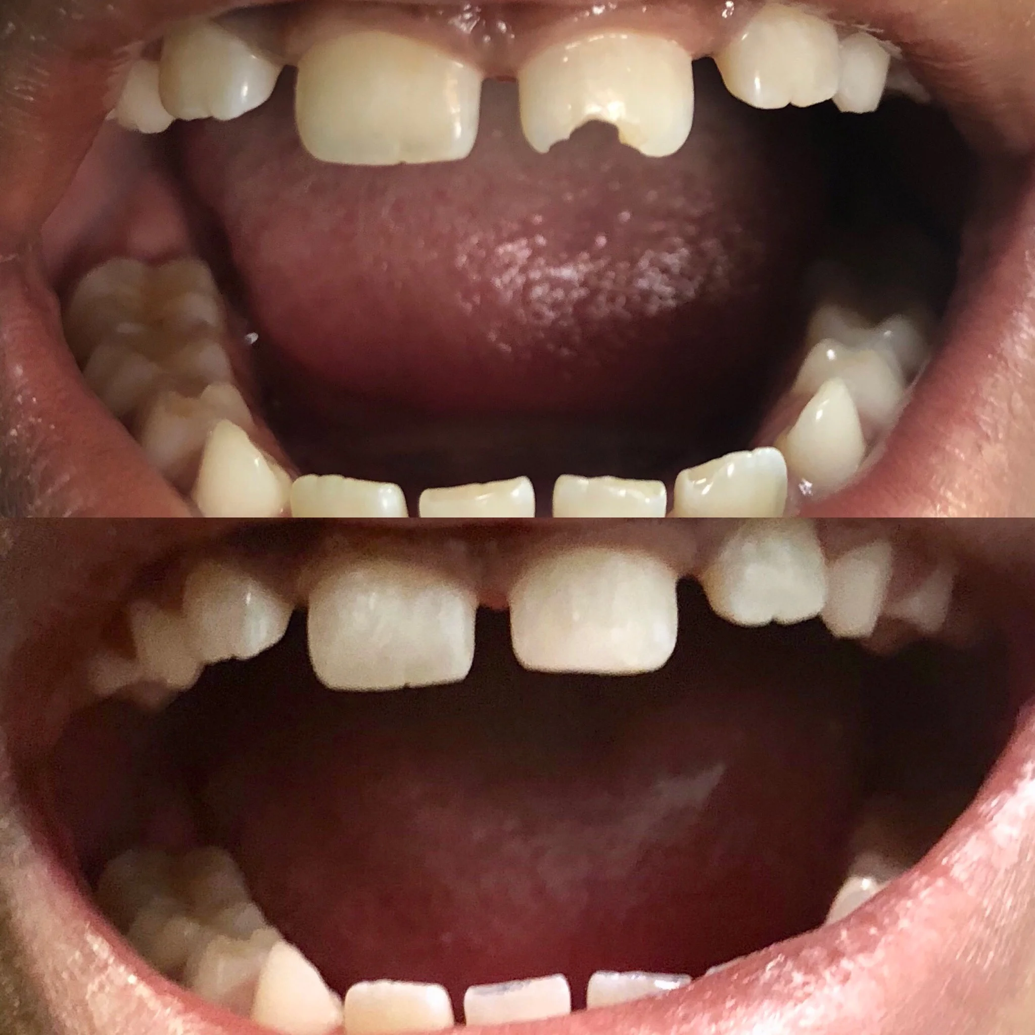 Fracture Repair