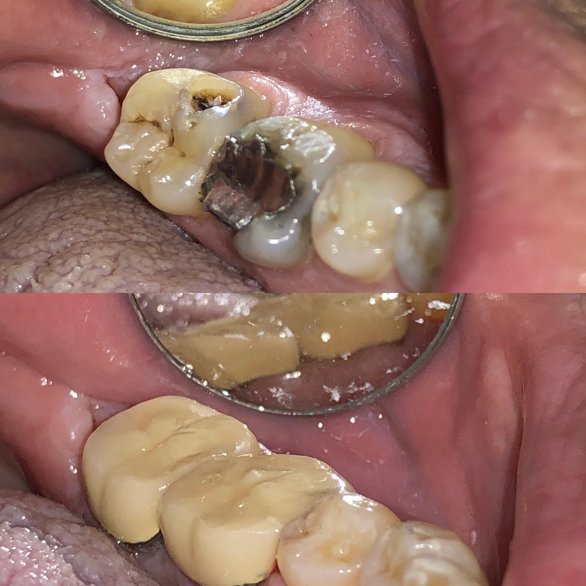 Decay Removal and Crowns