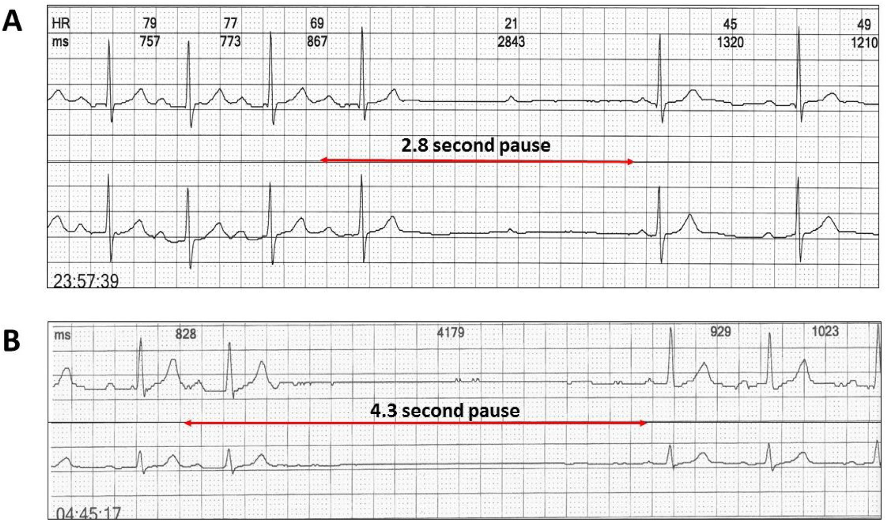 Figure 2 Two channel Holter monitor recordings of atypical Wenckebach AV sequences due to abrupt nocturnal slowing. A: Wenckebach AV sequence with a 2.8 second pause coinciding with the dropped beat. B: Wenckebach sequence interrupted by a 4.3 second sinus pause and hence no dropped beat.
