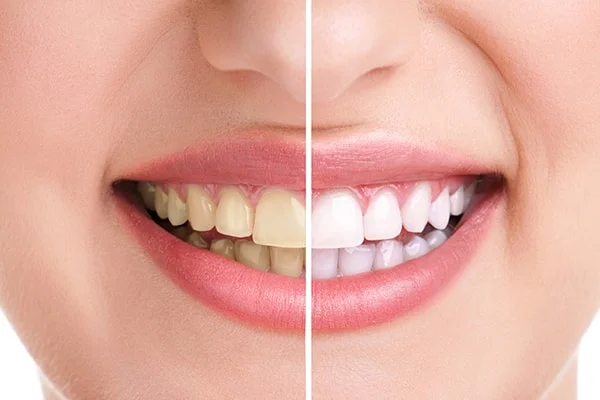 ¿El blanqueamiento daña mis dientes?