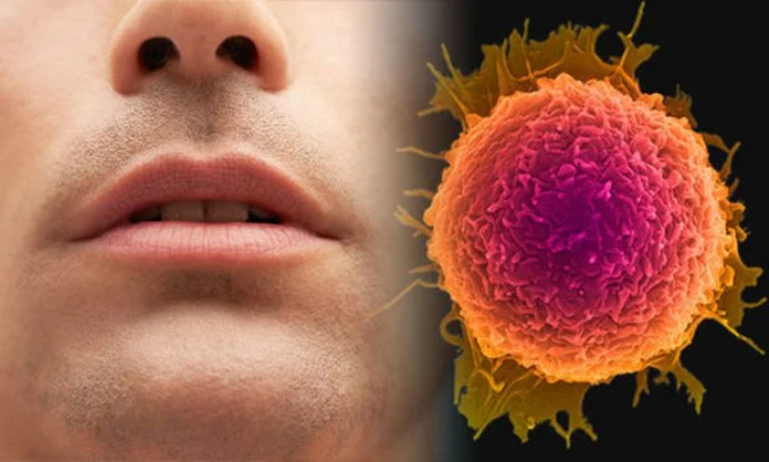 Cáncer oral y sus síntomas