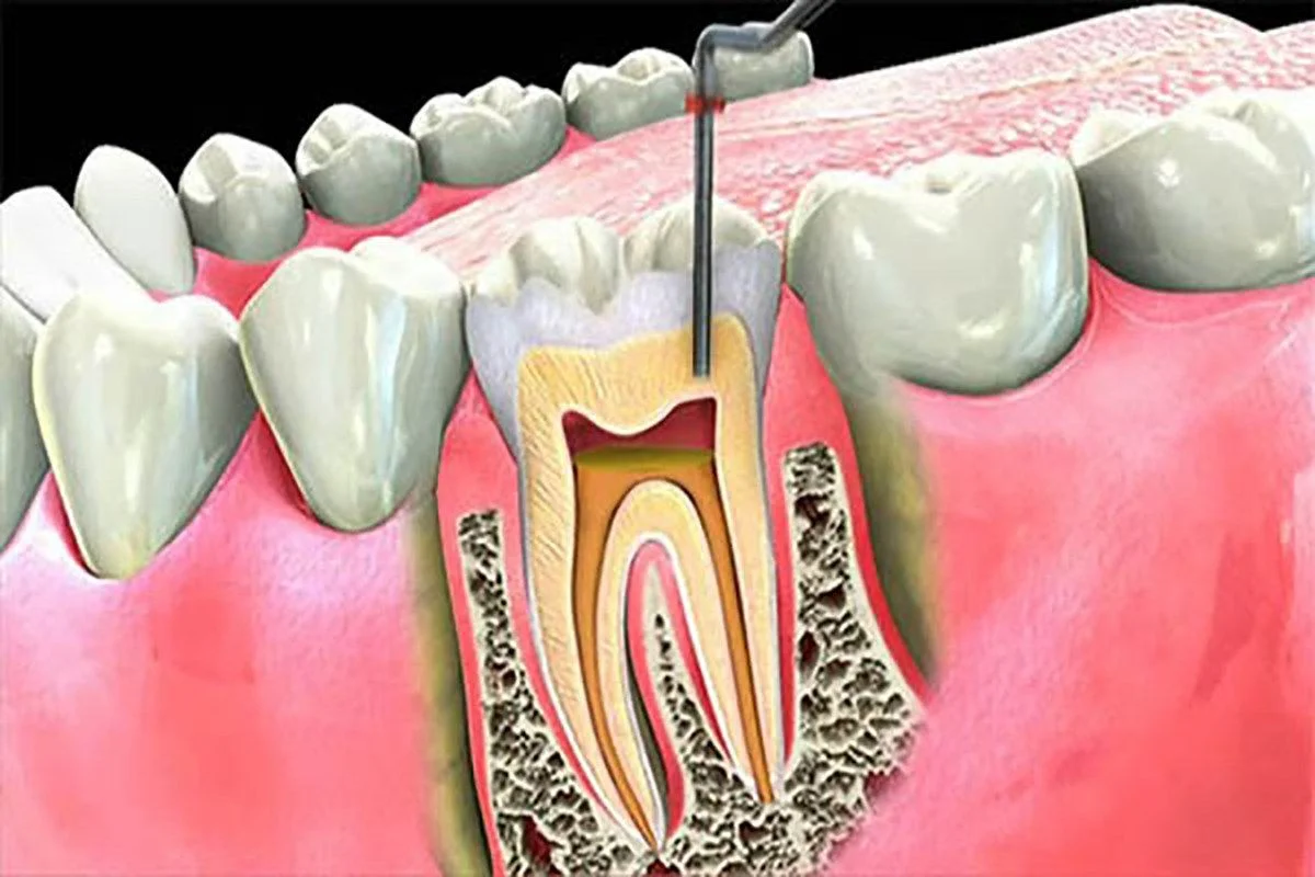 ¿Qué es una endodoncia?