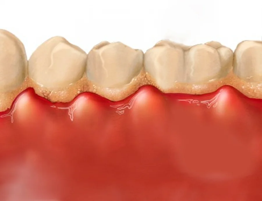 Pasos para eliminar la gingivitis