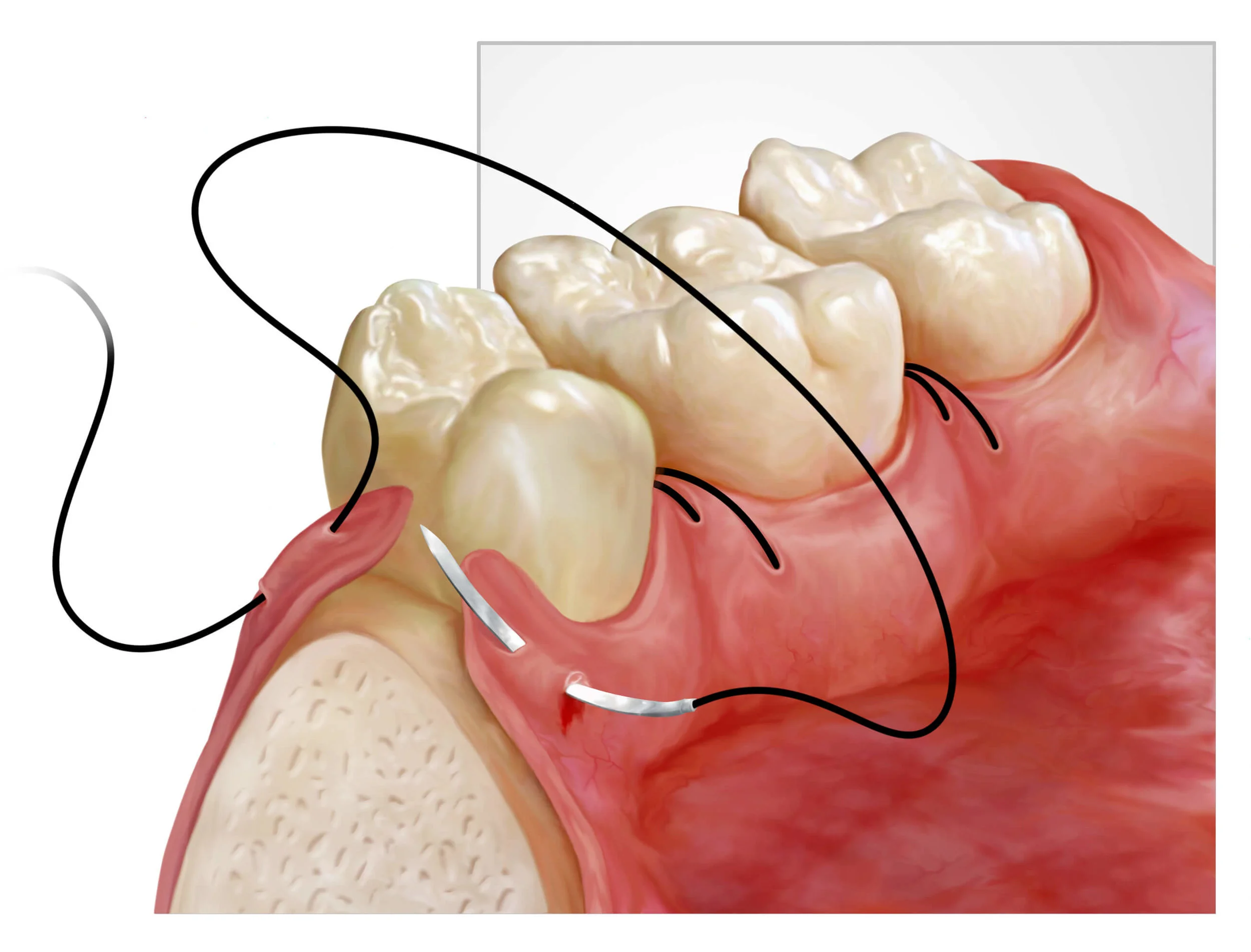 Las 5 cirugías más comunes que hace un dentista