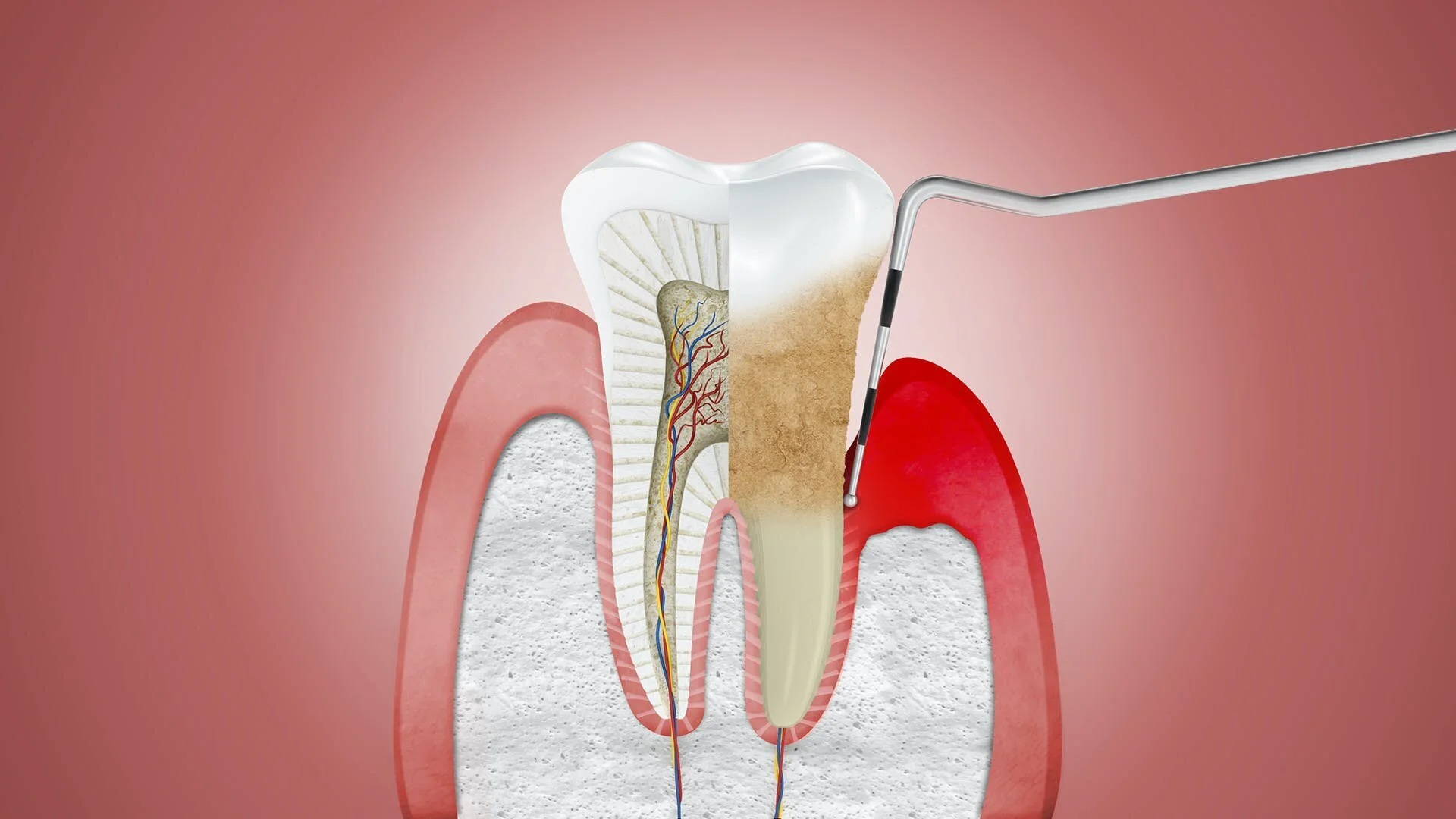 ¿Cómo se relaciona la periodontitis y el COVID?