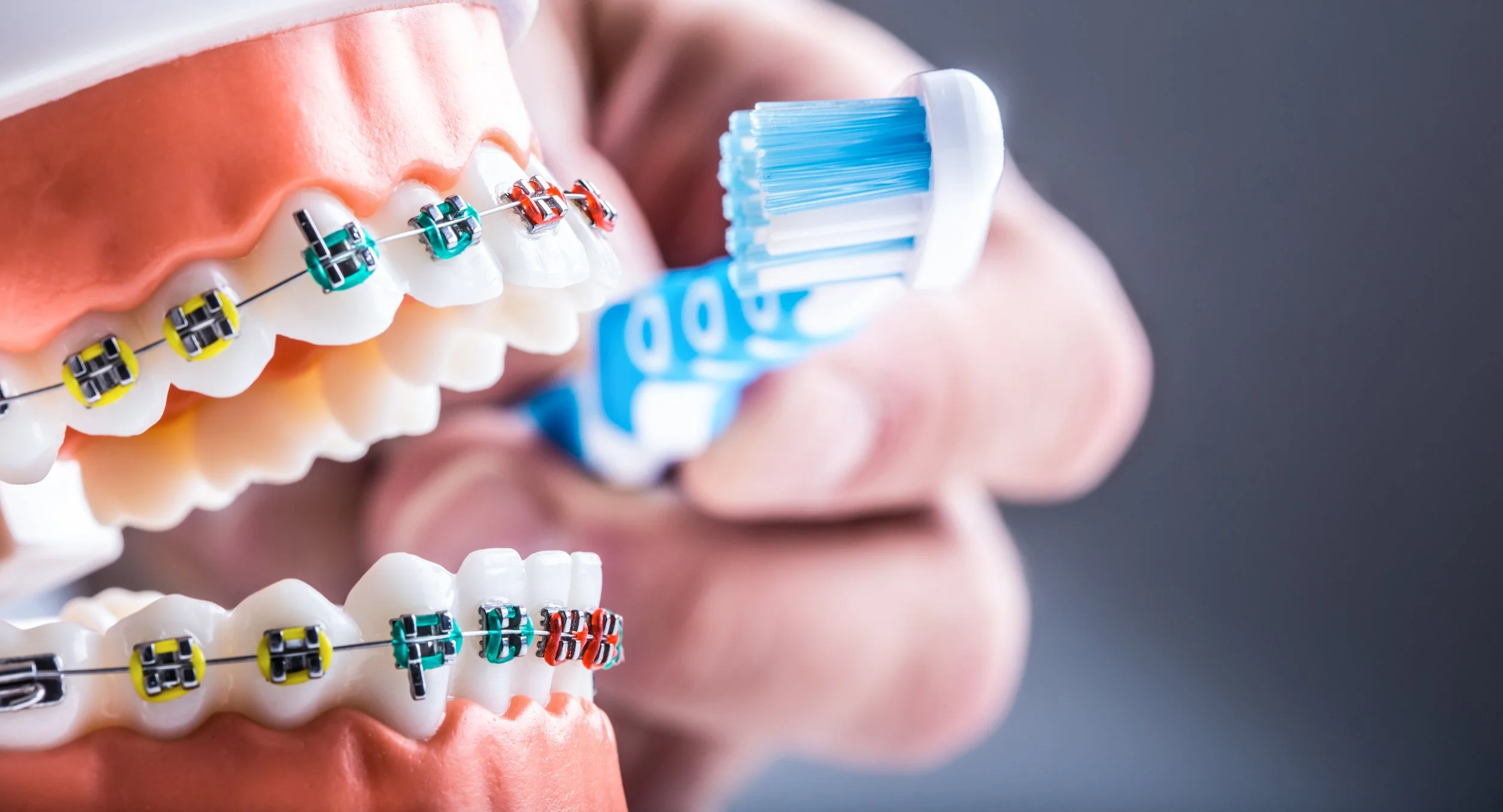 Limpieza de brackets, todo lo que debes saber
