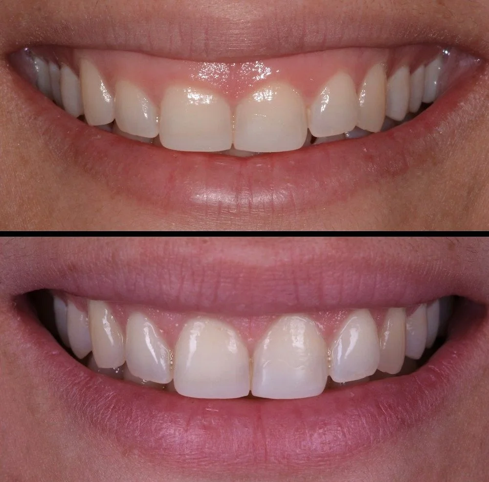 La sonrisa gingival, ¿afecta tu salud bucal?