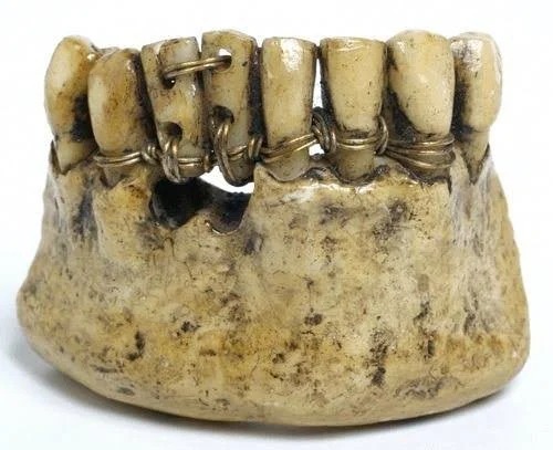 Los Primeros Brackets de la Historia: Un Viaje entre Alambres y Sonrisas