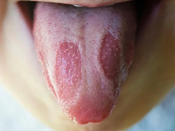 Lengua Geográfica: Una Condición Oral Benigna pero Desconcertante