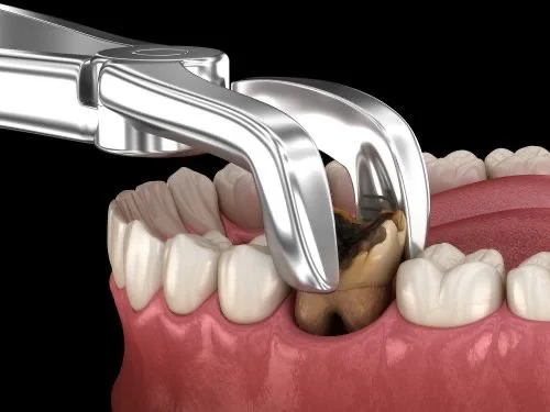 Endodoncia o Exodoncia: ¿Cuál Necesito?