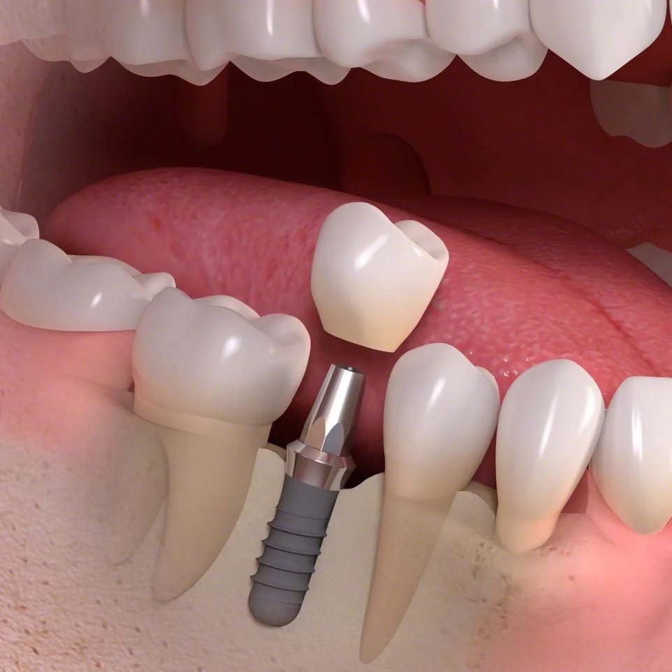 ¿Duele un implante dental?