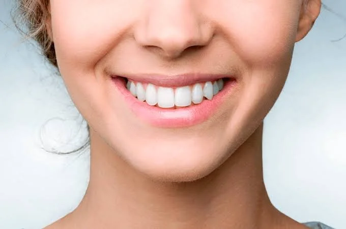Carillas dentales: la diferencia entre una sonrisa que se ve bien y una que se ve increíble
