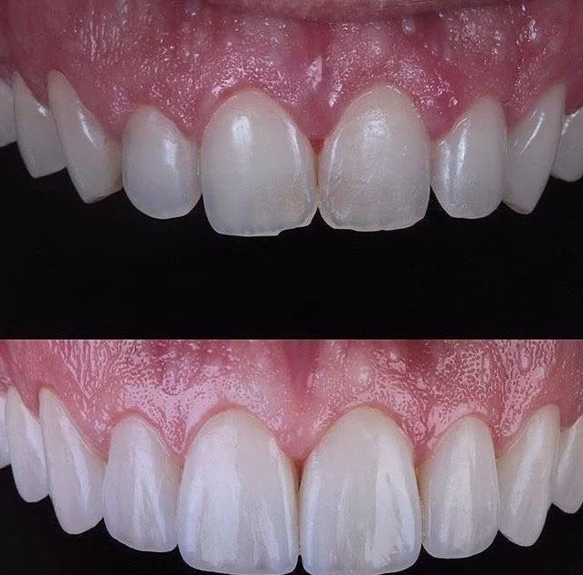 Estética y Diseño de Sonrisa: La Confluencia del Arte y la Odontología