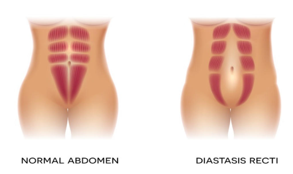 Diastasis Recti and Low Back Pain: Are They Related?  Pelvic Health  Physical Therapy - Morris County's Most Experienced Pelvic Floor Team