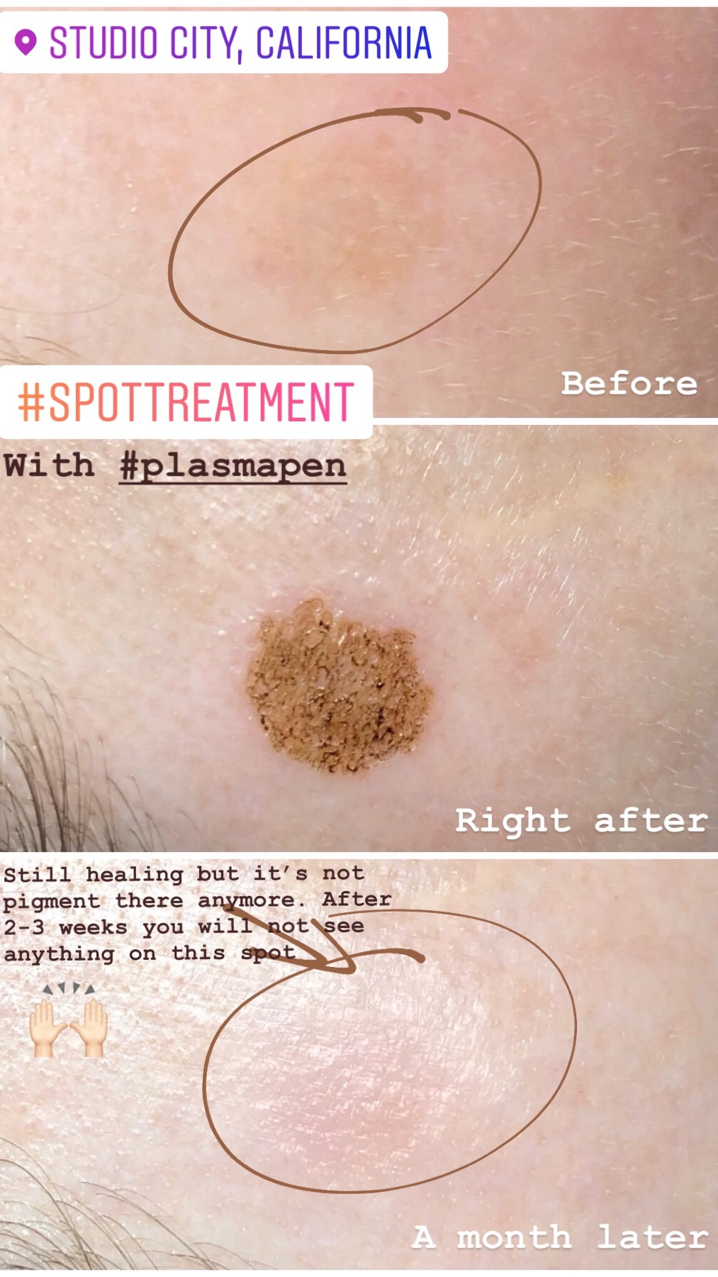 Fibroblast dark spot remover