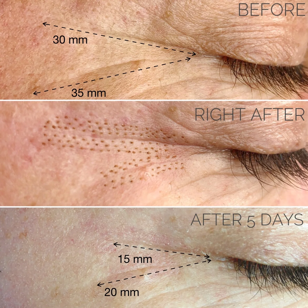Fibroblast wrinkle remover