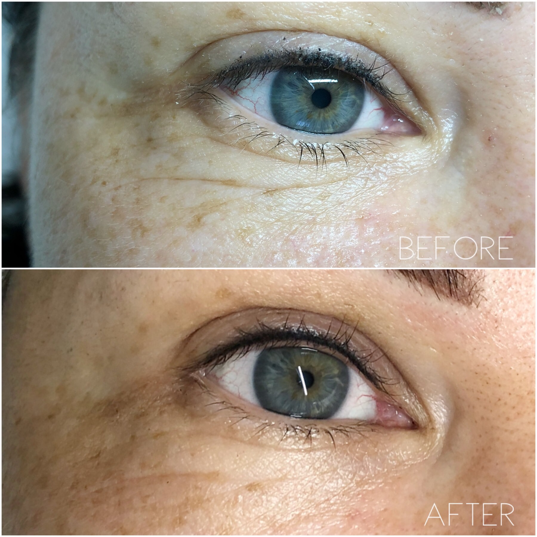 Fibroblast skin tightening