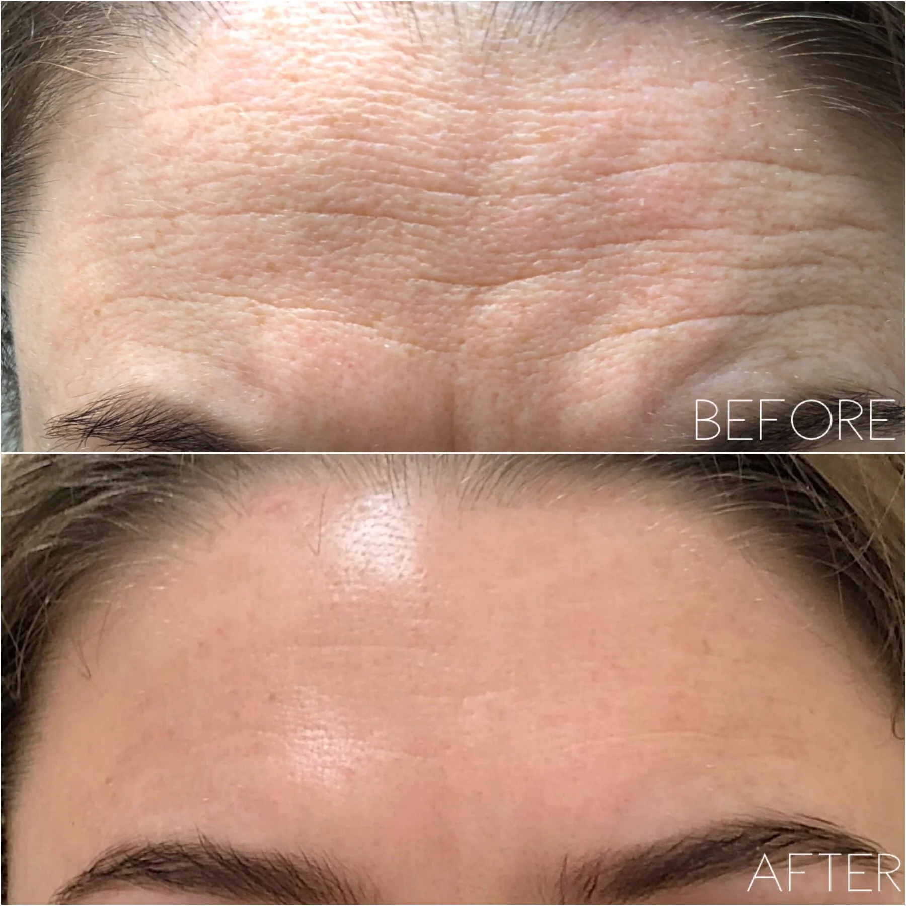 Fibroblast Skin Tightening