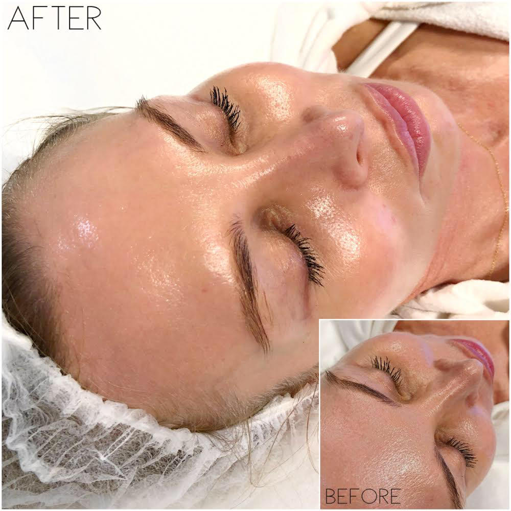 The HydraFacial vs Intraceuticals Oxygen Infusions