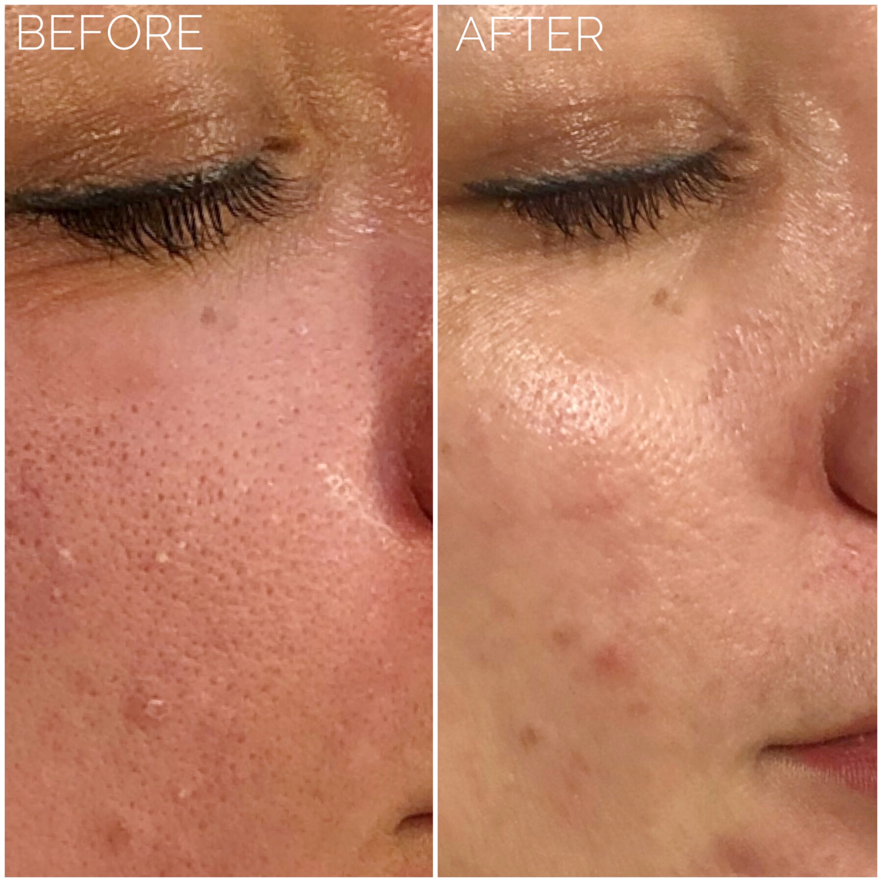 Rf Microneedling London