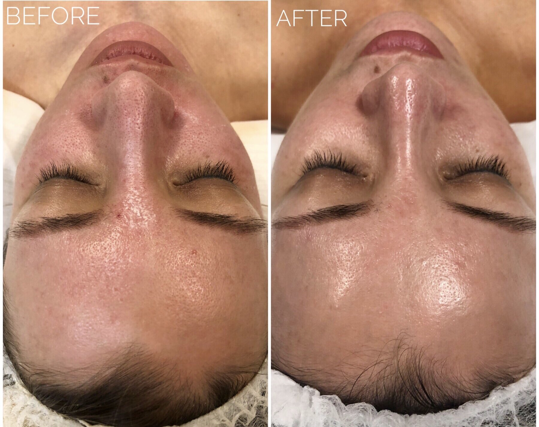 Chemical Peel : Why Winter Is The Best Time For it