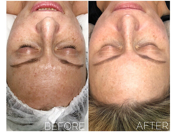 chemical peel for hyperpigmentation