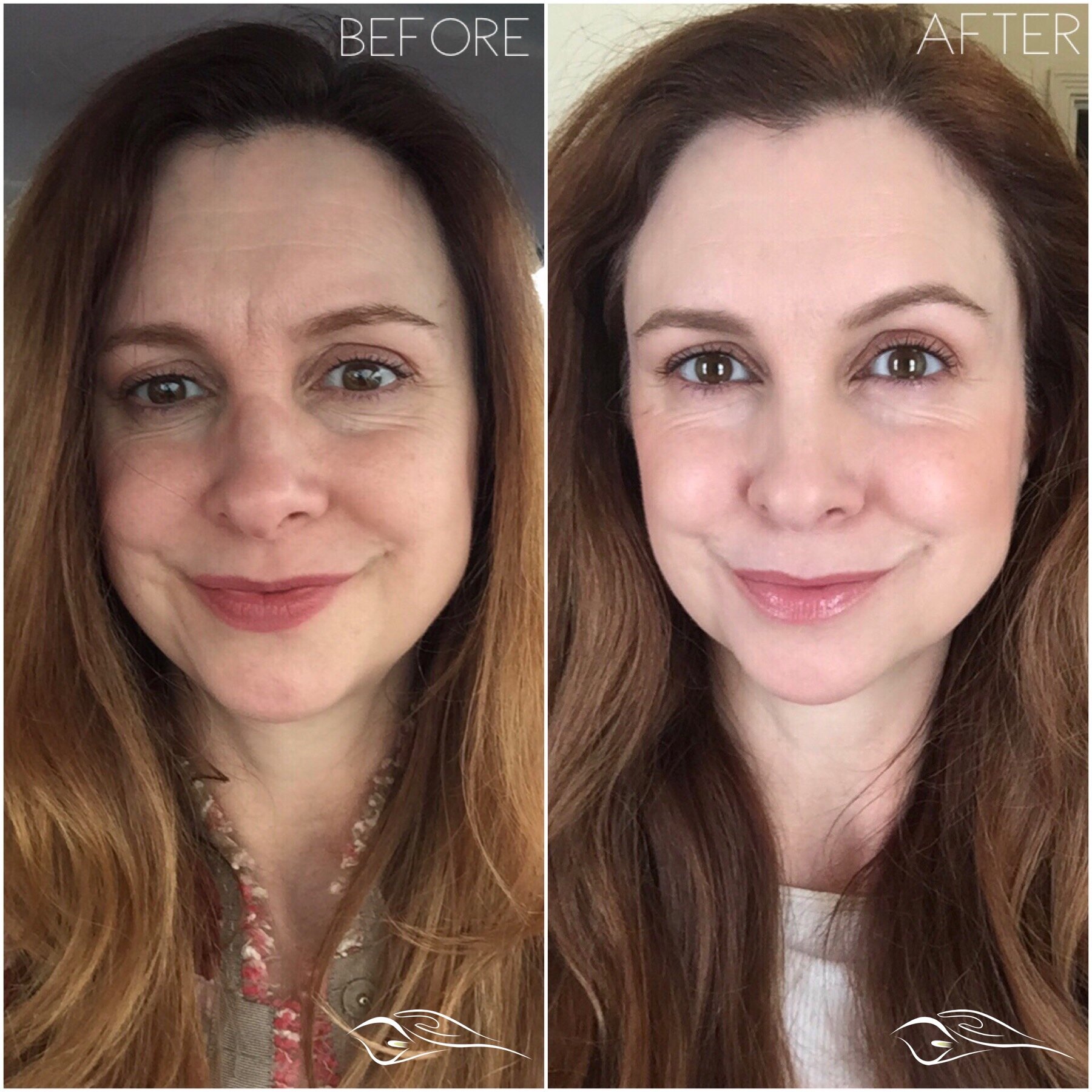 Radiofrequency Therapy vs Fibroblast Plasma Lift